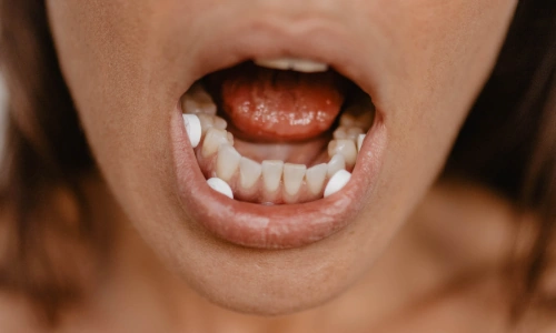 How to take misoprostol buccally - between cheeks and gums